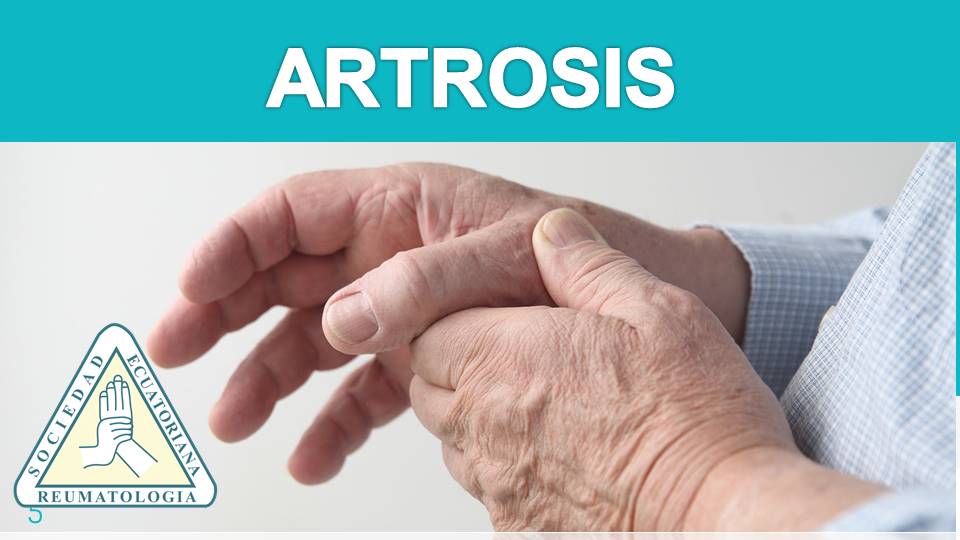 ✓ Artrosis En Las Manos, Diagnostico Y Tratamiento
