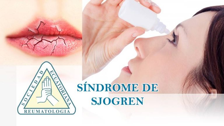 SÍNDROME DE SJÖGREN: QUÉ ES, SÍNTOMAS, DIAGNÓSTICO Y TRATAMIENTO ...